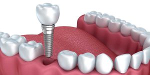 Zahnimplantat – wie lange tut es weh?